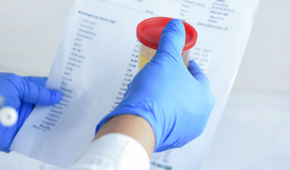 Загальний аналіз сечі: розшифровка показників, правила здачі